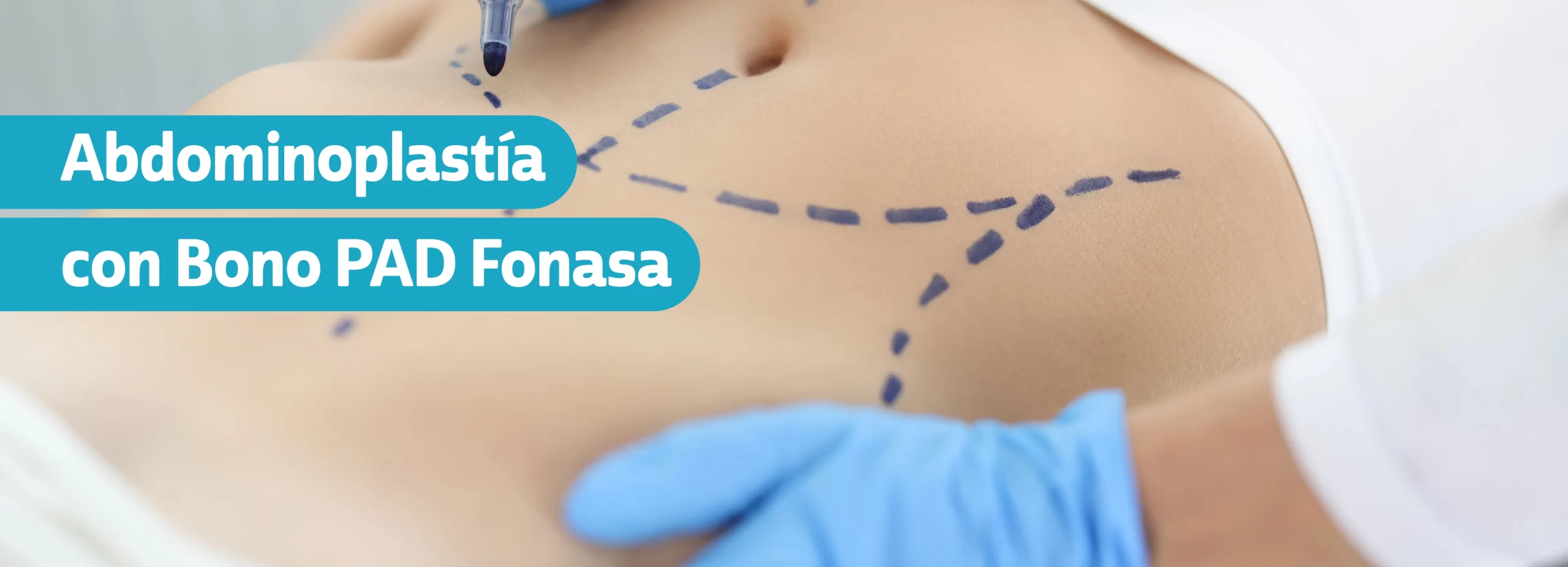 abdominoplastia con bono pad fonasa