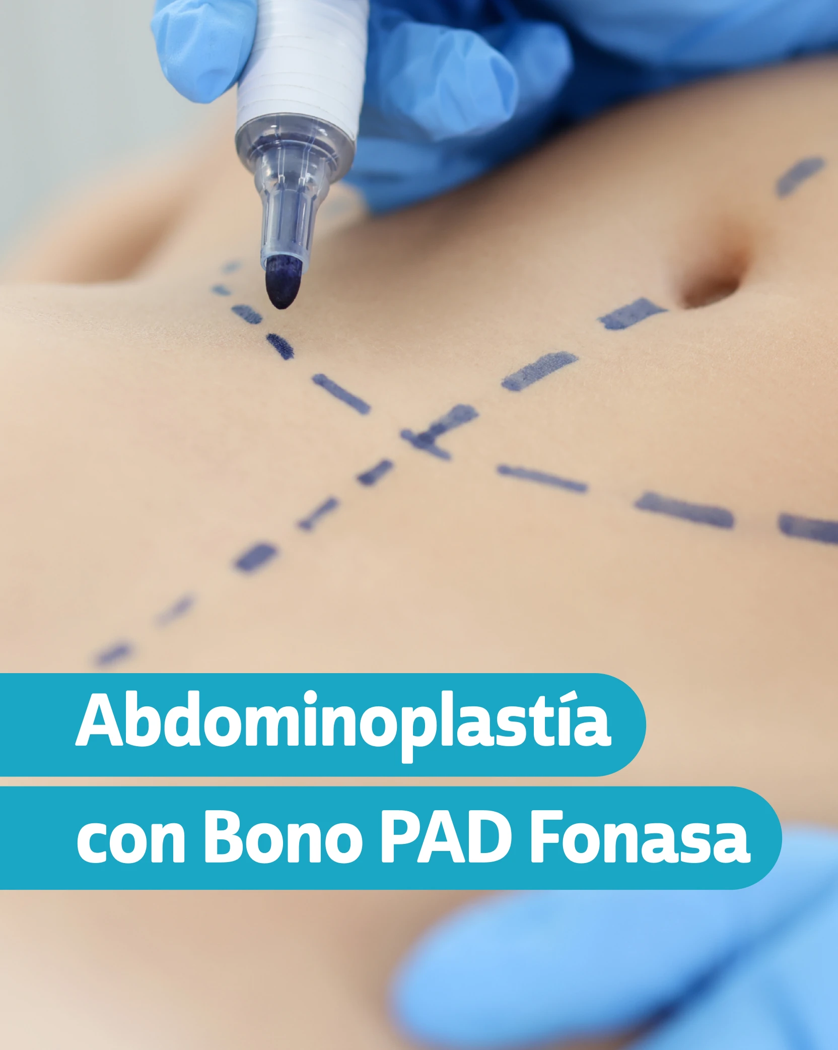 abdominoplastia bono pad fonasa